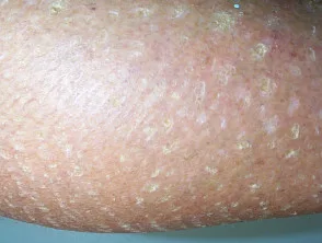 ichthyosis