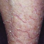 ichthyosis1__protectwyjqcm90zwn0il0_focusfillwzi5ncwymjisinkildm2xq-4809591-7273645-jpg-9920560