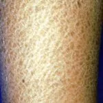 ichthyosis__protectwyjqcm90zwn0il0_focusfillwzi5ncwymjisinkildeznf0-4545952-5962029-jpg-3016586