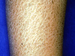 ichthyosis