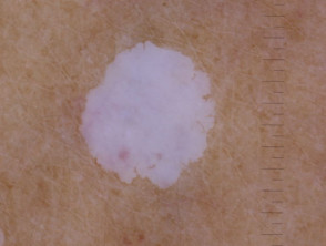 Hipomelanosis guttata idiopática
