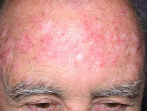 Imiquimod a queratosis actínica