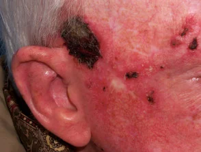 Imiquimod a queratosis actínica