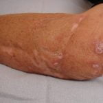 immunodeficiency-granuloma1__protectwyjqcm90zwn0il0_focusfillwzi5ncwymjisingildfd-5848987-4087241-jpg-2791589