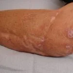 immunodeficiency-granuloma1__protectwyjqcm90zwn0il0_focusfillwzi5ncwymjisingildfd-5848987-4087241-jpg-2791589