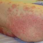 incontinenza-dermatite-02__protectwyjqcm90zwn0il0_focusfillwzi5ncwymjisingildfd-5942584-7873496-jpg-1705818