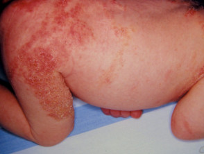 Incontinentia pigmenti en un recién nacido