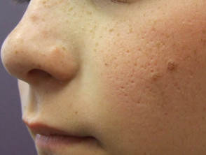 Cicatrices por acné infantil