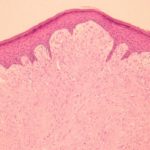 infantile-digital-fibromatosis-figure-1__protectwyjqcm90zwn0il0_focusfillwzi5ncwymjisingildfd-3735882-5018189-jpg-1139002