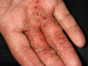 Vesikuläre Dermatitis der infizierten Hand