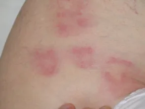 Interstitiële granulomateuze dermatitis