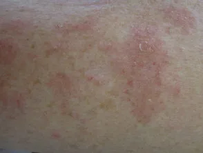 Interstitiële granulomateuze dermatitis