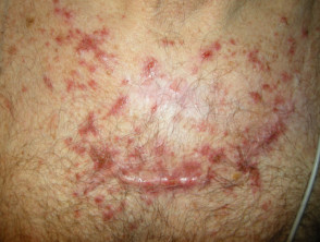 Dermatitis granulomatosa intersticial