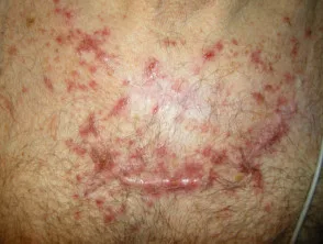 Interstitiële granulomateuze dermatitis