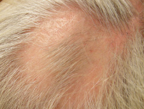 Inyección intralesional de esteroides para la alopecia areata
