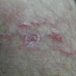 intralymphatische-Histiozytose__protectwyjqcm90zwn0il0_focusfillwzi5ncwymjisingilde4xq-9357634-7775657-jpg-5286619