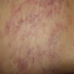 linfoma-intravascolare-01__protectwyjqcm90zwn0il0_focusfillwzi5ncwymjisingildfd-2063149-2002096-jpg-3850136