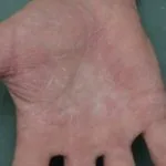 dermatite-da-contatto-irritante-001__protectwyjqcm90zwn0il0_focusfillwzi5ncwymjisingildiwxq-2388680-1179551-jpg-5946394
