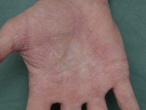 Dermatitis irritante de las manos por contacto