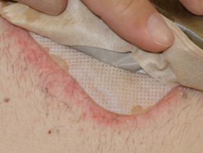 Dermatitis de contacto irritante alrededor del aparato de estoma
