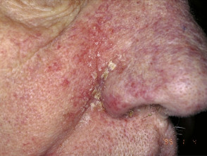 Dermatitis seborreica