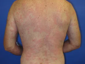 urticaria