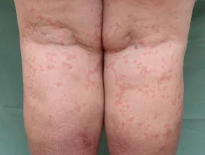 urticaria