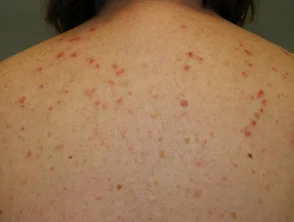 Dermatitis veroorzaakt door immunoglobuline-injecties