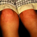 juvenile-arthritis-1__protectwyjqcm90zwn0il0_focusfillwzi5ncwymjisingildfd-3939070-1638438-jpg-7158740