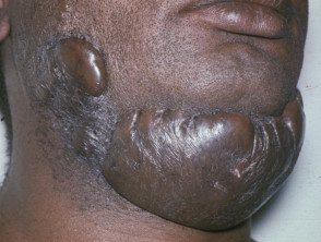 Cicatriz queloide en piel tipo VI