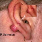 keloid01__protectwyjqcm90zwn0il0_focusfillwzi5ncwymjisinkilde4xq-4406754-8761201-jpg-2386161