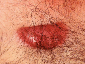 Cicatriz queloide