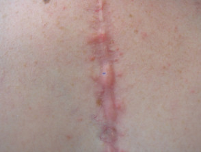 Cicatriz queloide