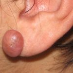 keloid9__protectwyjqcm90zwn0il0_focusfillwzi5ncwymjisingildfd-3580754-9516118-jpg-4533224
