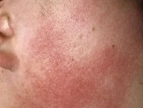 keratose pilaris