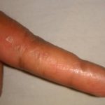 keratoelastoidosis-marginalis-04__protectwyjqcm90zwn0il0_focusfillwzi5ncwymjisingildfd-6208052-6455538-jpg-9916625