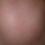 keratosis-circumscripta1__protectwyjqcm90zwn0il0_focusfillwzi5ncwymjisinkildy3xq-4560318-6266797-jpg-6996714