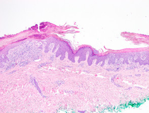 Chronische lichenoide Keratose Abbildung 4
