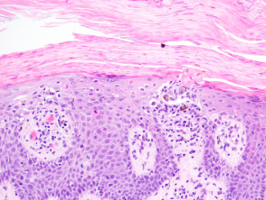 Chronische lichenoide Keratose Abbildung 5