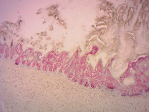 Melanoma queratótico in situ teñido con SOX10 x20