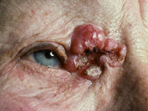 Carcinoma de células basales de alto riesgo