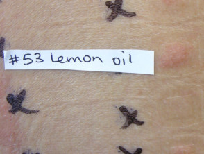 Pruebas de parche positivas al aceite de limón