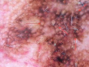 Círculos concéntricos (flechas rojas) observados en la dermatoscopia de melanoma lentigo maligno