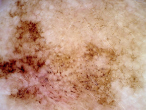 Aberturas foliculares pigmentadas asimétricas en la dermatoscopia de lentigo maligno