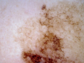 Aberturas foliculares pigmentadas asimétricas en la dermatoscopia de lentigo maligno