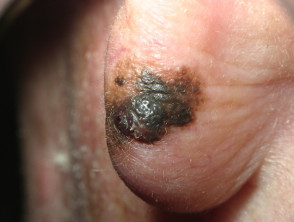 Melanoma lentigo maligno 0,98 mm