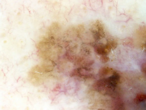 Melanoma lentigo maligno, Breslow 0,8 mm