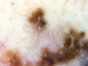 Melanoma lentigo maligno, Breslow 0,8 mm