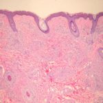 leprosy-figure-1__protectwyjqcm90zwn0il0_focusfillwzi5ncwymjisingildfd-3149404-6878049-jpg-5005526