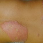 leprosy3__protectwyjqcm90zwn0il0_focusfillwzi5ncwymjisingildfd-4565456-4666880-jpg-9571561